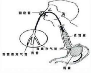 球囊壓迫止血 球囊壓迫止血