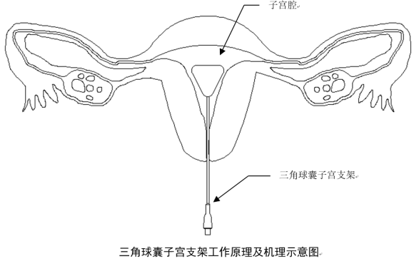 球囊技術在醫學上的應用