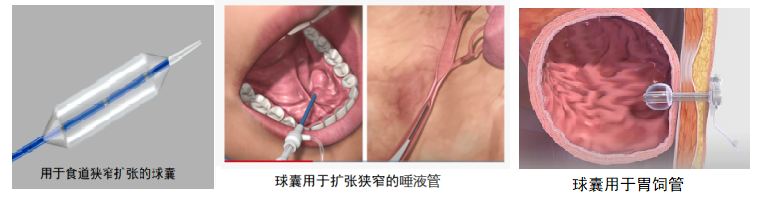 球囊技術在醫學上的應用
