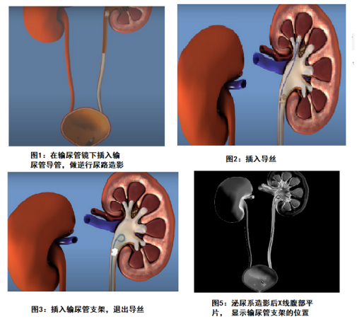 輸尿管支架的應用