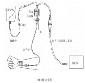 一次性血壓傳感器使用時間問題