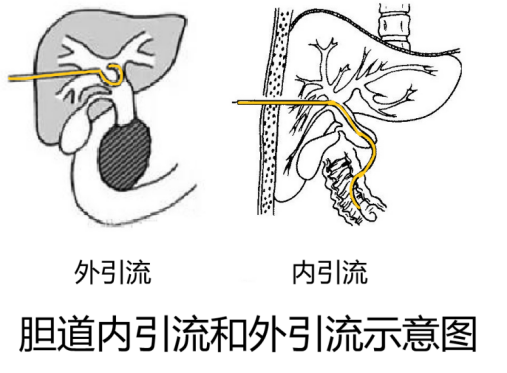 膽道引流