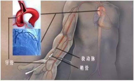 為什么越來(lái)越多的人選用橈動(dòng)脈穿刺點(diǎn)做血管介入