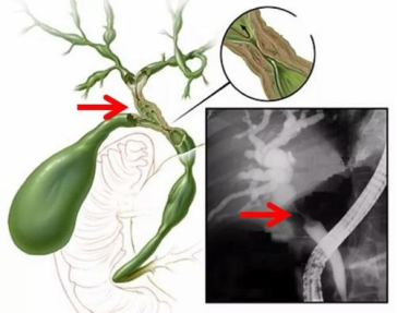 經皮肝穿刺+膽道引流術 有關問題的解答 經皮肝穿刺+膽道引流術 有關問題的解答