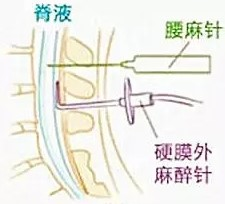 椎管內麻醉比較
