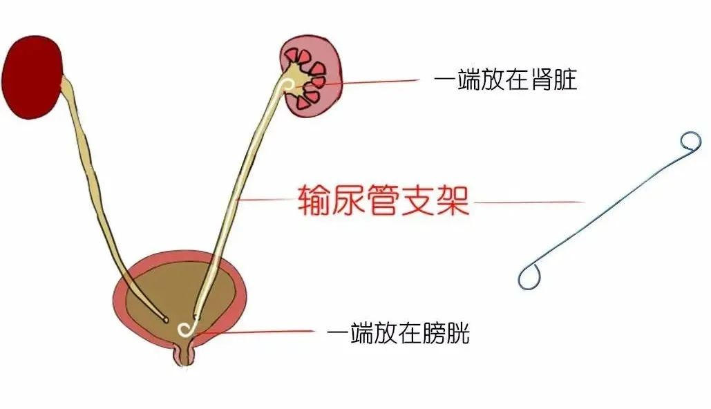 輸尿管支架的由來和使用注意事項