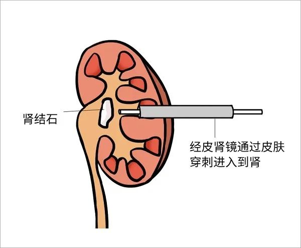 科普 | 經皮腎鏡碎石術