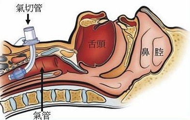 氣管切開套管護理要點