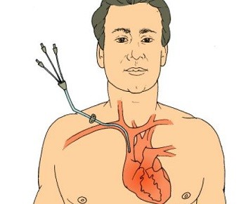 產(chǎn)品推薦：中心靜脈導(dǎo)管