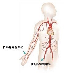 為什么越來越多的人選用橈動脈穿刺點做血管介入