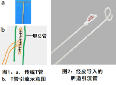 經(jīng)皮經(jīng)肝膽管引流術(shù)
