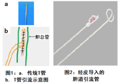 肝膽管引流術