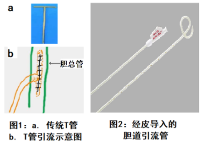 肝穿膽道引流術
