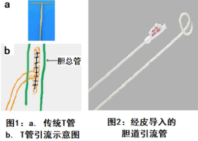 肝膽引流技術