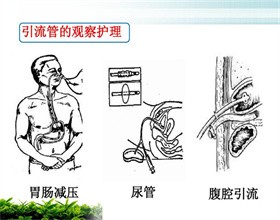 腹腔引流管