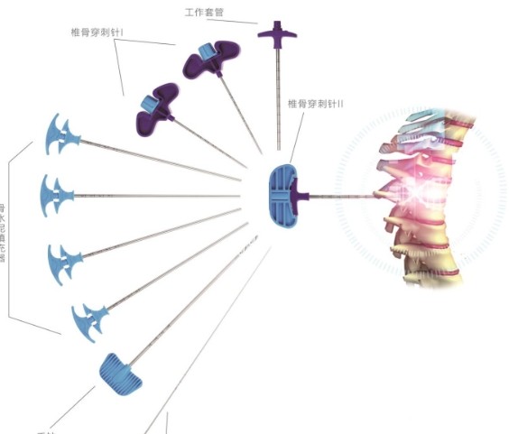椎體成形擴張器的價格